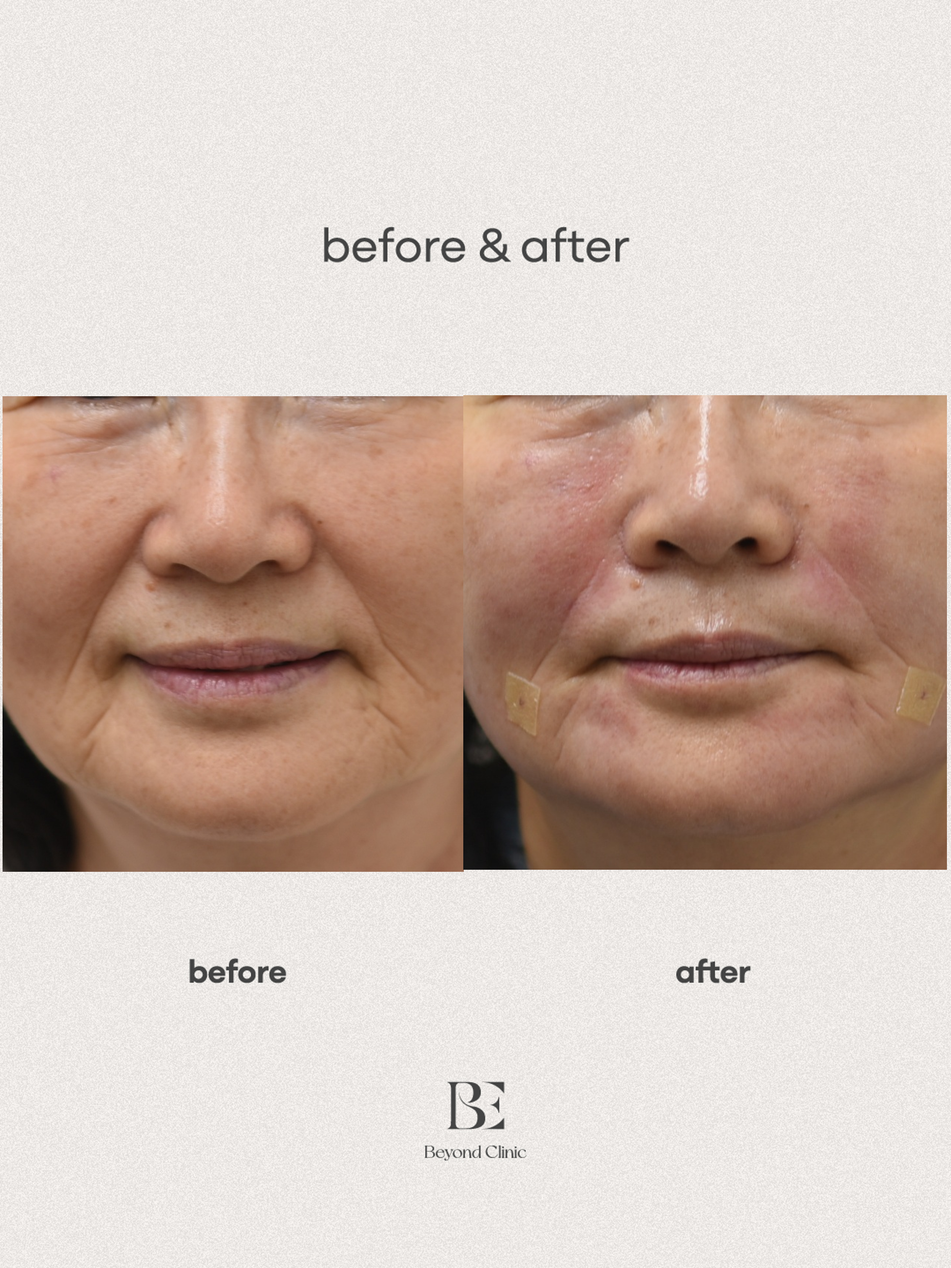 팔자+마리오네트 레디어스