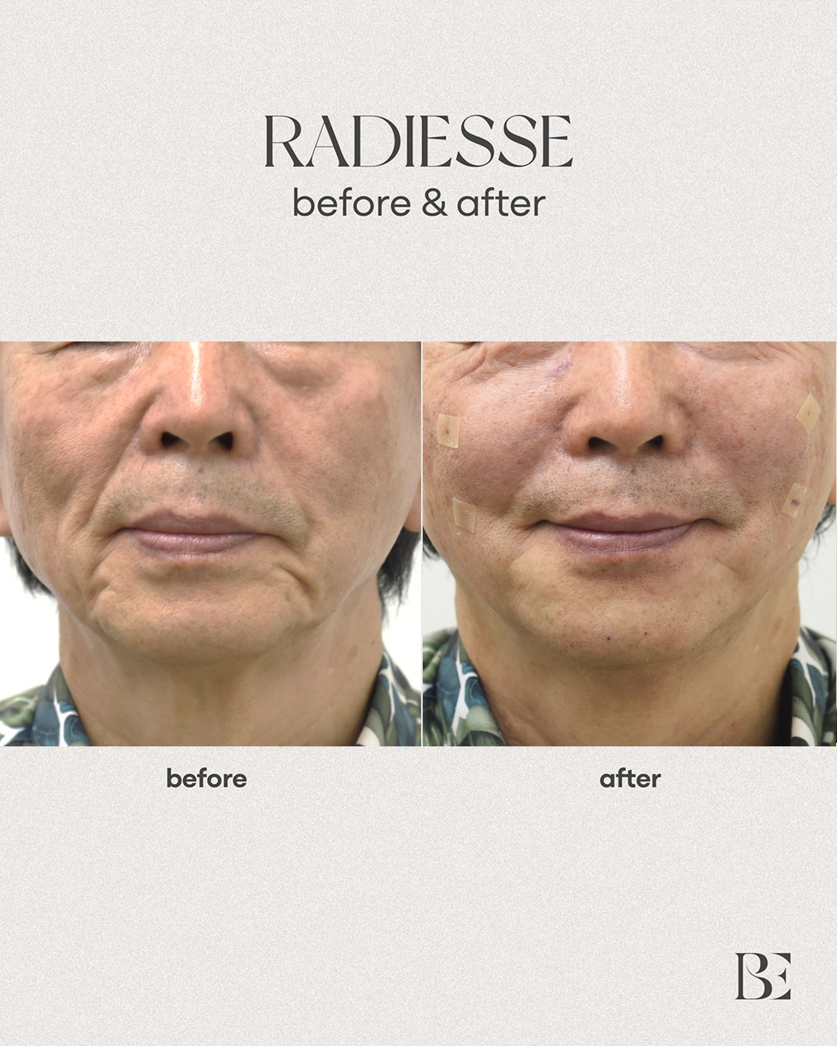RADIESSE