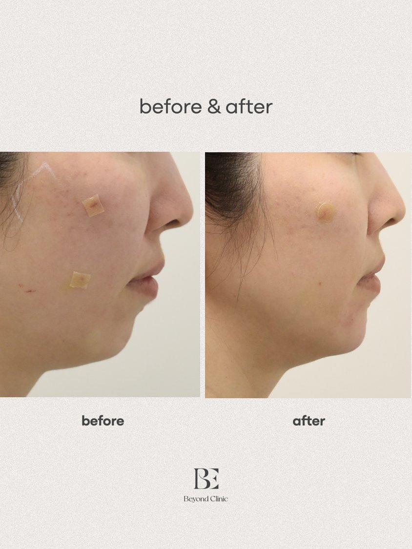chin filler
