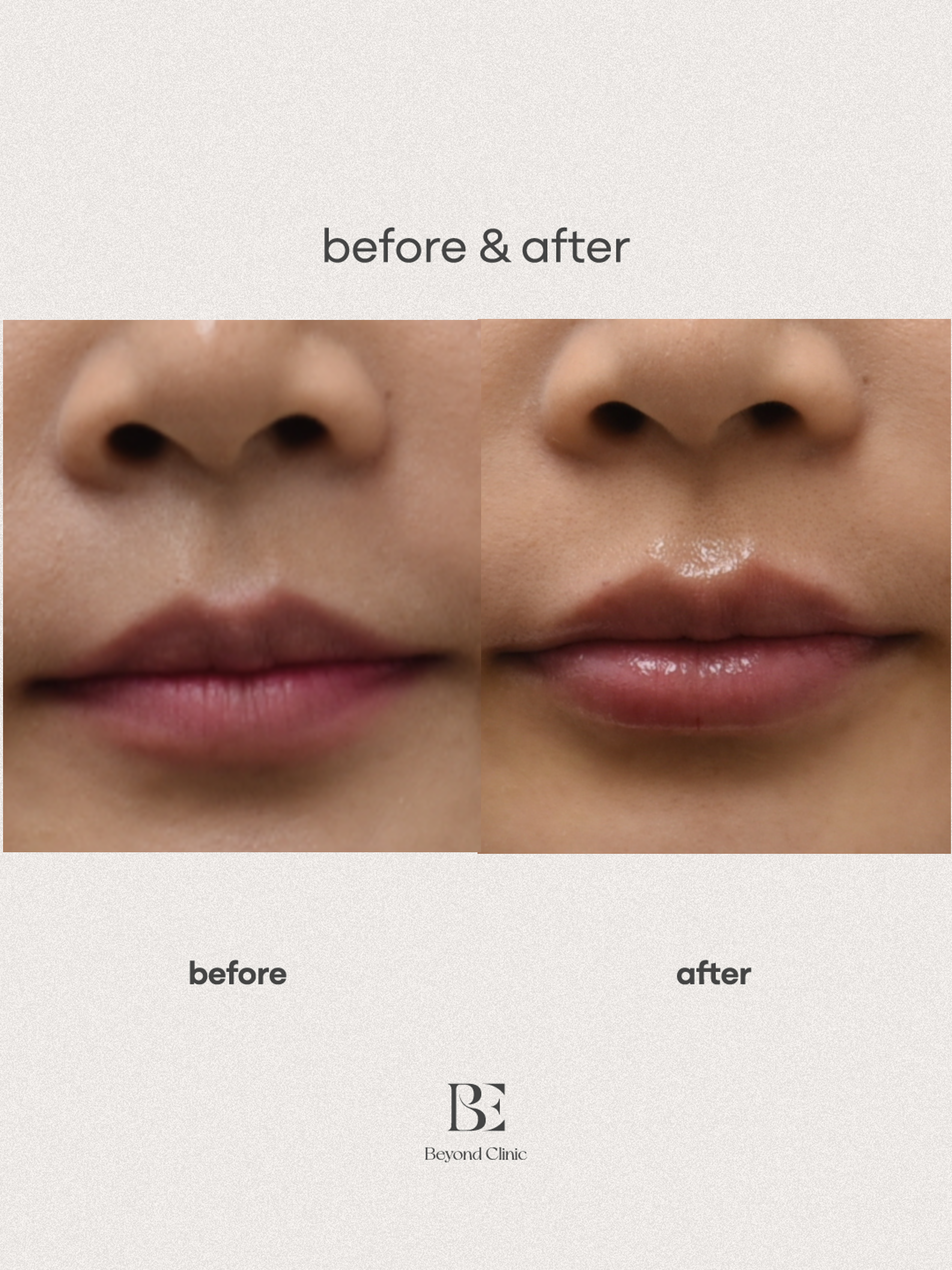 Lip filler