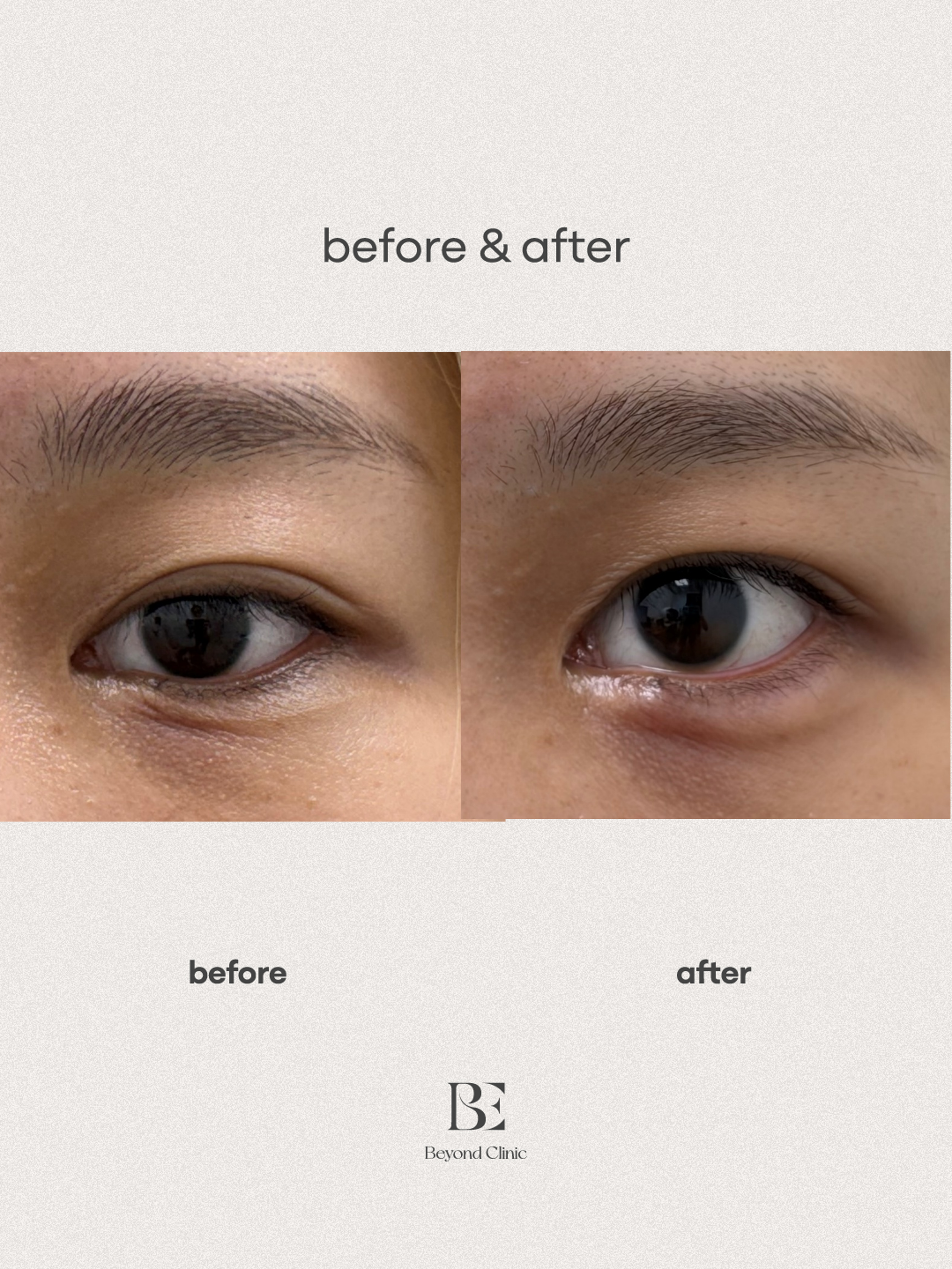 Pretarsal (Ae-gyo sal) Filler