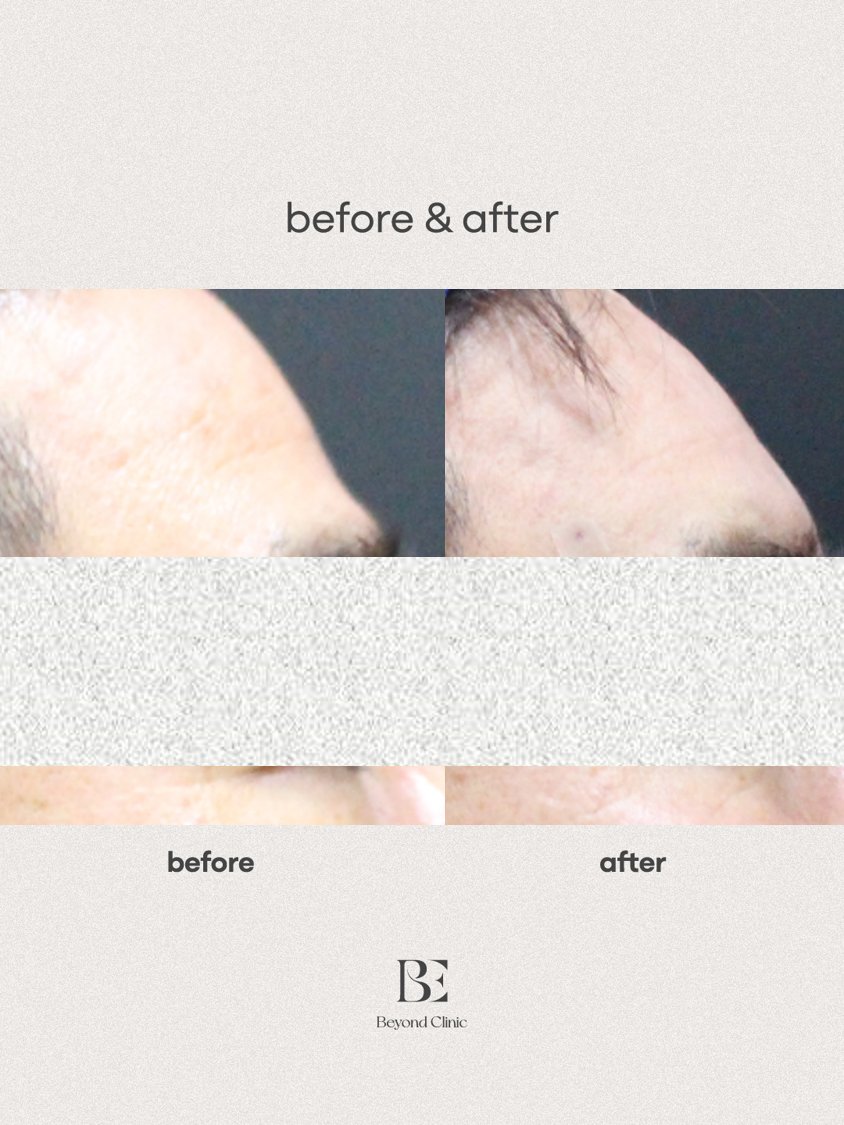 forehead filler