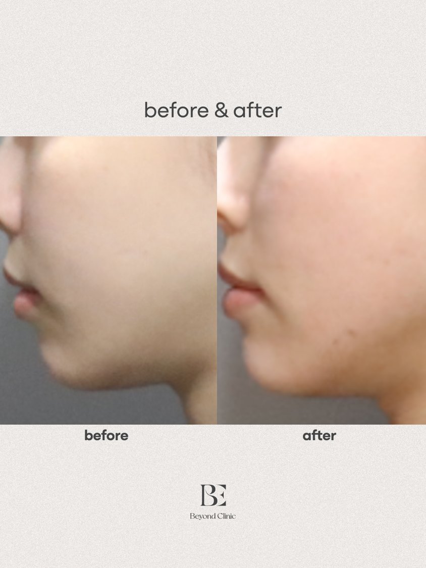 chin filler