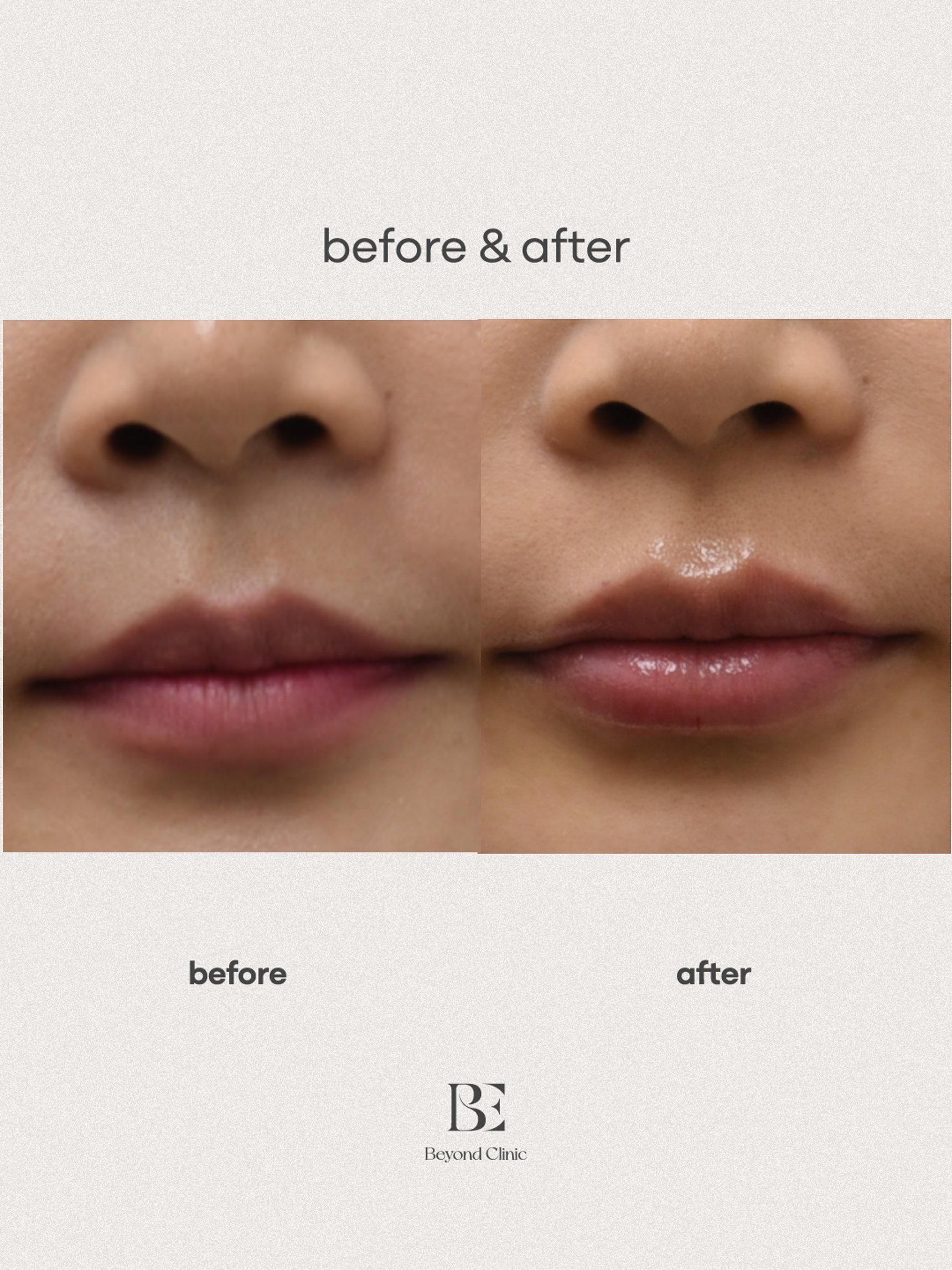 Lip filler